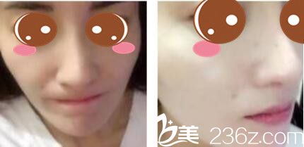 韓國李斗榮美笑整形外科李斗榮假體隆鼻真人案例術(shù)后十八天 韓國李斗榮美笑整形外科李斗榮假體隆鼻真人案例術(shù)后十八天