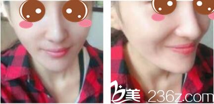 一個(gè)月前找韓國(guó)李斗榮美笑做下頜角切除出門(mén)的李斗榮做了假體隆鼻