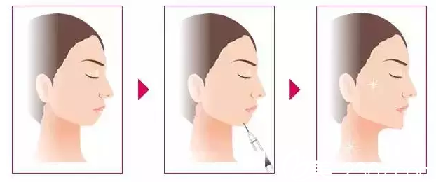 玻尿酸注射豐下巴原理 玻尿酸注射豐下巴原理