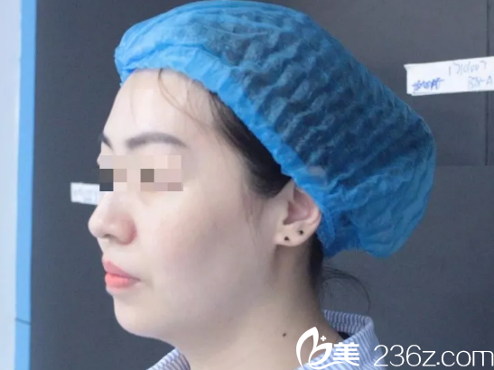 術(shù)前下巴輕微后縮 術(shù)前下巴輕微后縮