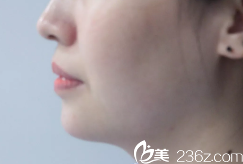 剛做完注射豐下巴術(shù)后即刻 剛做完注射豐下巴術(shù)后即刻