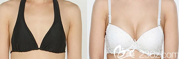 娜娜整形黃銅淵院長自體脂肪豐胸案例 娜娜整形黃銅淵院長自體脂肪豐胸案例