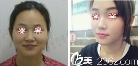 毛鈺婷玻尿酸豐太陽穴案例 毛鈺婷玻尿酸豐太陽穴案例