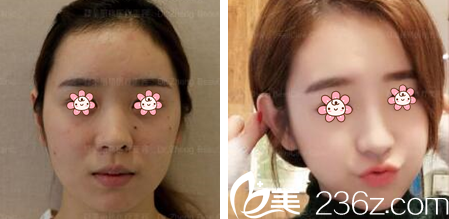 周業(yè)松院長面部線雕案例 周業(yè)松院長面部線雕案例