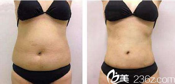 娜娜整形外科醫(yī)院腰部抽脂案例