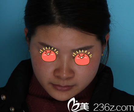 找寧波薇琳曾舉做隆鼻前 找寧波薇琳曾舉做隆鼻前