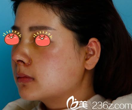 做完隆鼻手術7天拆線<span style= 做完隆鼻手術7天拆線<span style=