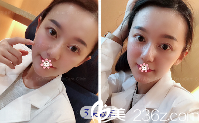 周業(yè)松面部線雕提升加玻尿酸填充蘋果肌術后第三天 周業(yè)松面部線雕提升加玻尿酸填充蘋果肌術后第三天