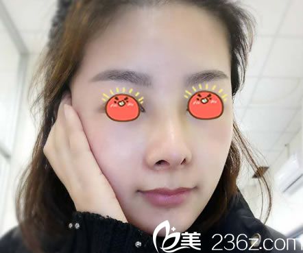 寧波薇琳醫(yī)美做隆鼻20天恢復圖 寧波薇琳醫(yī)美做隆鼻20天恢復圖