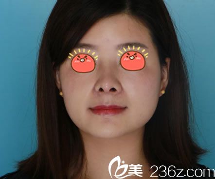 寧波薇琳隆鼻<span style= 寧波薇琳隆鼻<span style=