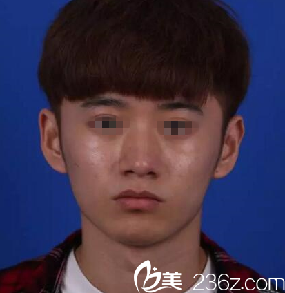 在桂林時光美萊做鼻綜合手術(shù)前 在桂林時光美萊做鼻綜合手術(shù)前