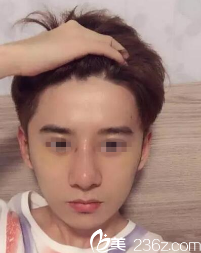 在桂林時光美萊做鼻綜合手術(shù)后7天 在桂林時光美萊做鼻綜合手術(shù)后7天