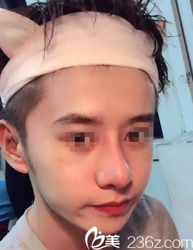 在桂林時光美萊做鼻綜合手術(shù)后2周 在桂林時光美萊做鼻綜合手術(shù)后2周