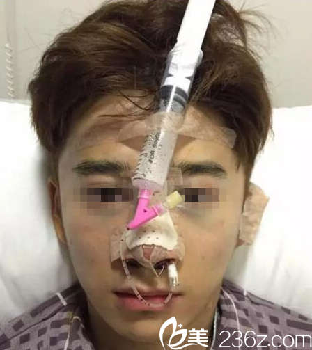 在桂林時光美萊做鼻綜合手術(shù)當(dāng)天 在桂林時光美萊做鼻綜合手術(shù)當(dāng)天