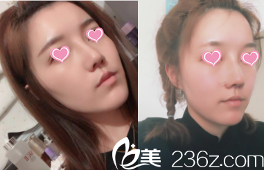 看北京米揚(yáng)麗格巫文云夏正義聯(lián)合給我打造鼻綜合面部脂肪填充效果朋友說(shuō)靠譜