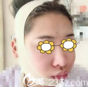 下頜角術后天照