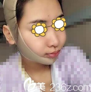 下頜角整形術后第3天照