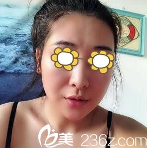 下頜角整形手術術后半個月效果