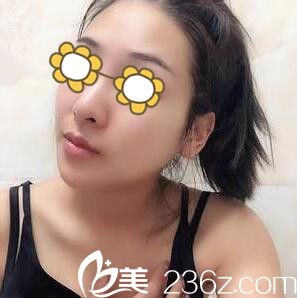 在韓國美友整形醫(yī)院做了下頜角術(shù)后我終于如愿擁有想要的上鏡“V”字臉