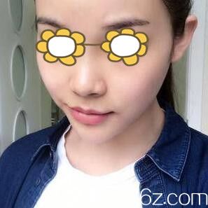 鼻綜合整形術(shù)前照 鼻綜合整形術(shù)前照