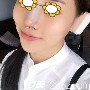 鼻綜合術(shù)后第三天 鼻綜合術(shù)后第三天