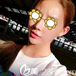 鼻綜合整形半個(gè)月 鼻綜合整形半個(gè)月