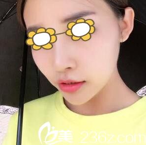 趁著暑假去韓國女友整形醫(yī)院做了鼻綜合手術(shù)現(xiàn)在恢復(fù)挺不錯(cuò)的