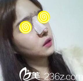 鼻整形術(shù)后第3天