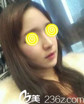 鼻整形半個(gè)月