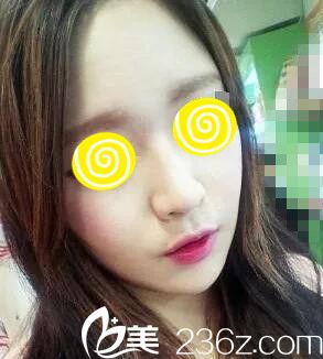 鼻整形術(shù)后1個(gè)月<span style=