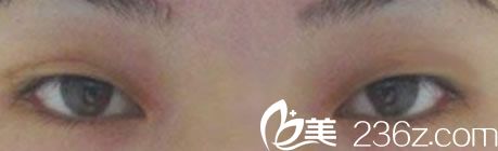 娜娜整形醫(yī)院手術(shù)前圖片