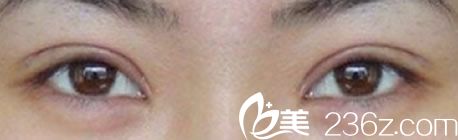 崔相錄醫(yī)生全切雙眼皮恢復(fù)后案例