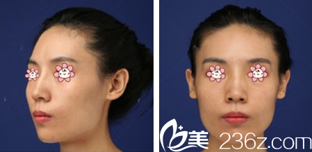 術(shù)前的我 術(shù)前的我