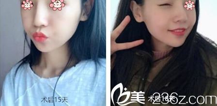 韓國JSTAR整形外科顴弓內(nèi)推和下頜角整形術(shù)后半個(gè)多月 韓國JSTAR整形外科顴弓內(nèi)推和下頜角整形術(shù)后半個(gè)多月