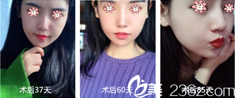 術(shù)后快三個(gè)月了 術(shù)后快三個(gè)月了