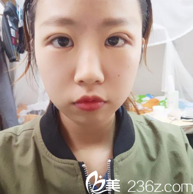 找廣州博仕整形醫(yī)院李帥敏做完雙眼皮術(shù)后三天 找廣州博仕整形醫(yī)院李帥敏做完雙眼皮術(shù)后三天