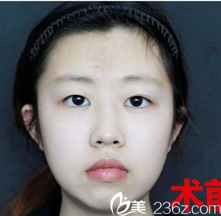 廣州博仕整形醫(yī)院李帥敏雙眼皮術(shù)前 廣州博仕整形醫(yī)院李帥敏雙眼皮術(shù)前