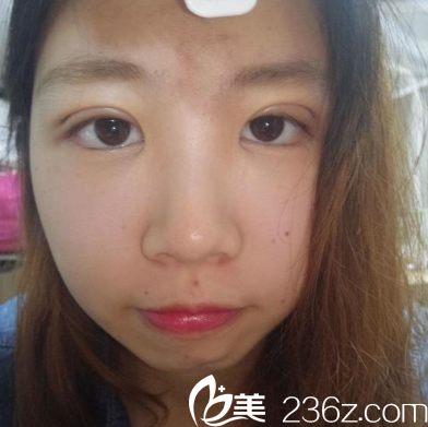 廣州博仕整形醫(yī)院李帥敏雙眼皮術(shù)后五天細(xì)節(jié)圖 廣州博仕整形醫(yī)院李帥敏雙眼皮術(shù)后五天細(xì)節(jié)圖