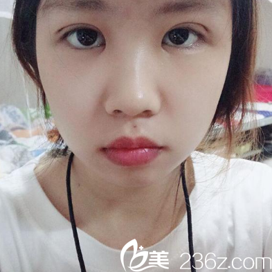 廣州博仕整形醫(yī)院李帥敏雙眼皮7天拆線效果 廣州博仕整形醫(yī)院李帥敏雙眼皮7天拆線效果