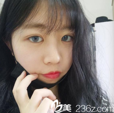 找廣州博仕整形醫(yī)院李帥敏做完雙眼皮半個月了 找廣州博仕整形醫(yī)院李帥敏做完雙眼皮半個月了