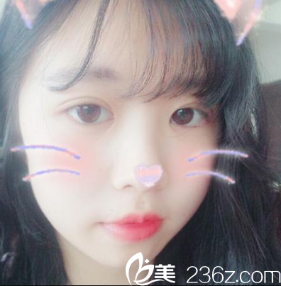 閨蜜直夸我找廣州博仕整形醫(yī)院李帥敏做的雙眼皮效果自然又好看