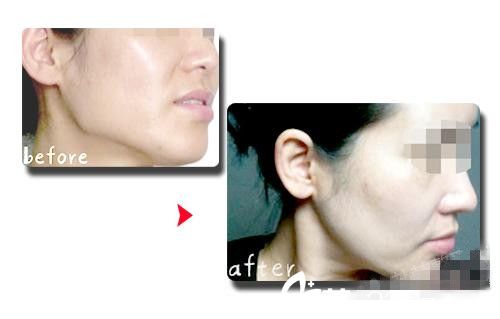 韓國伍人整形醫(yī)院下頜角手術(shù)案例分享