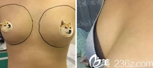 韓國娜娜整形外科醫(yī)院自體脂肪隆胸手術(shù)前 韓國娜娜整形外科醫(yī)院自體脂肪隆胸手術(shù)前