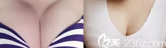 我的美麗蛻變從韓國(guó)娜娜整形醫(yī)院自體脂肪隆胸開始 重塑傲人雙峰不是夢(mèng)