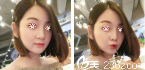 我趁在韓留學(xué)工夫去了韓國(guó)KAIROS整形林鐘學(xué)那兒做了玻尿酸填充太陽(yáng)穴墊下巴。