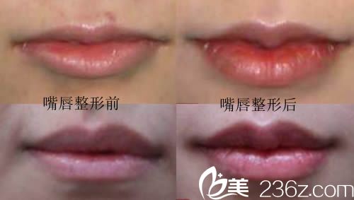 韓國青春整形外科嘟嘟唇案例效果圖