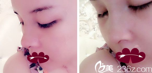 合肥韓美羅定安隆鼻失敗修復+自體脂肪填充全臉術后第3天恢復情況