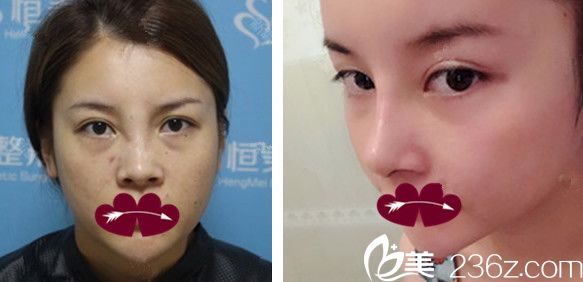 隆鼻失敗修復+面部填充自體脂肪前后對比圖