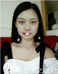 術前的我 術前的我