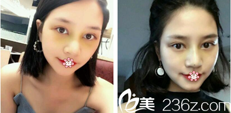 <!--<i data=20240703-sp></i>-->杰切開雙眼皮加硅膠假體隆鼻術后半個月 <!--<i data=20240703-sp></i>-->杰切開雙眼皮加硅膠假體隆鼻術后半個月